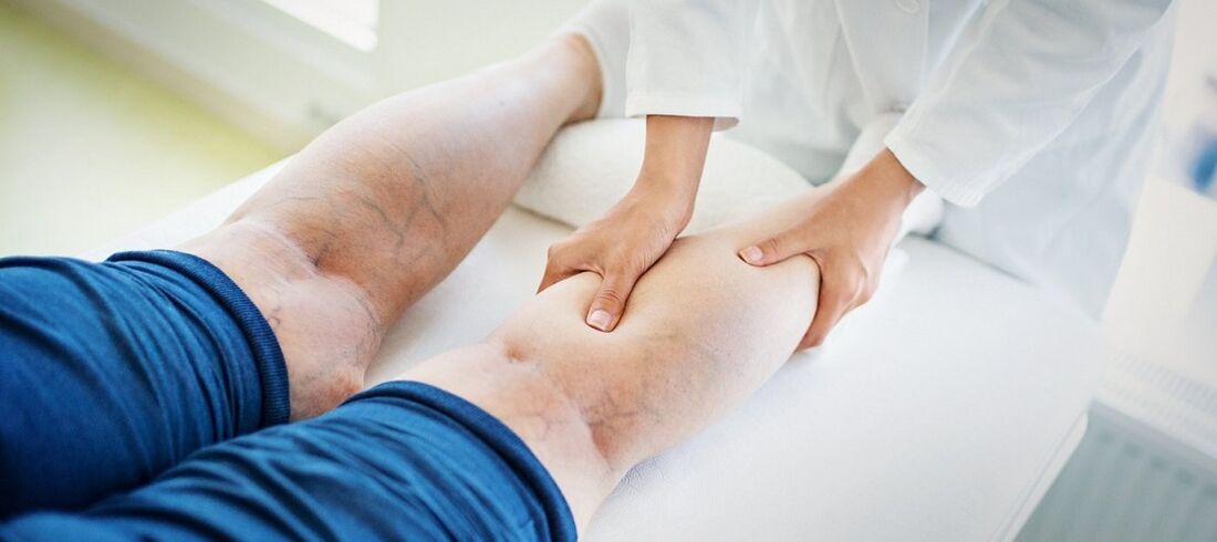 Varices nas pernas e o seu tratamento