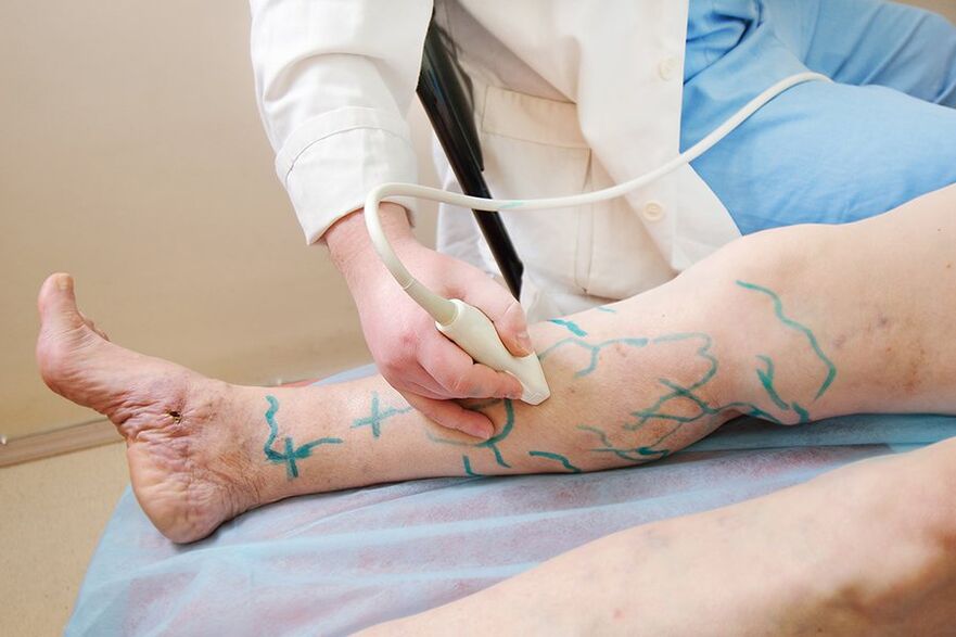 Preparación para miniflebectomía marcado nos perforadores da parte inferior da perna, realizando sonografía